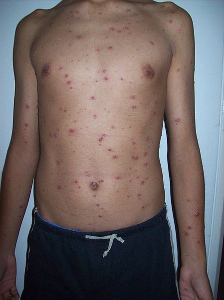 Varicela: Remedios caseros para la varicela.