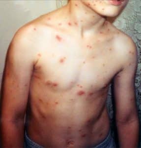 La varicela en niños