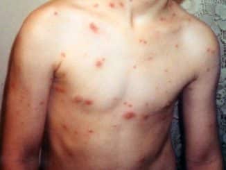 La varicela en niños